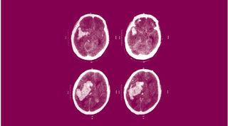 left cerebral hemisphere, 导致大脑向右侧偏移, 造成了严重的颅内高压